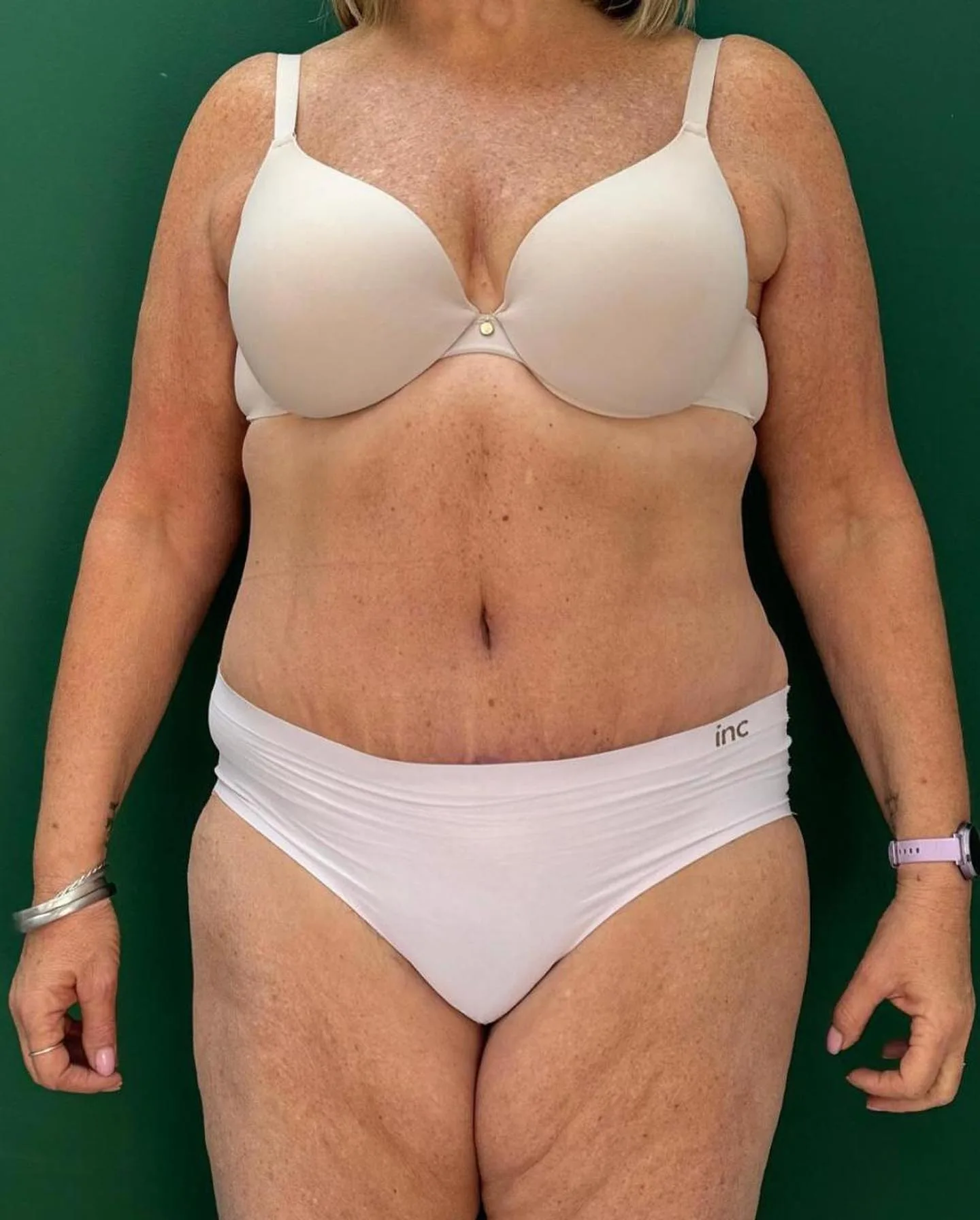 Abdominoplasty After